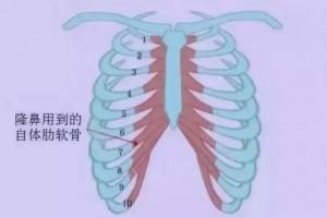 明星网红都爱的隆鼻方式 哪些人适合做肋软骨隆鼻?