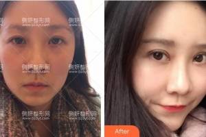 深圳广和整形美容医院尹卫民隆鼻手术怎么样附最新价格表