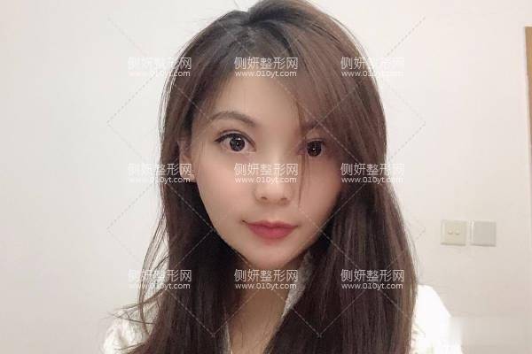 上海百达丽医疗美容怎么样？附割双眼皮前后对比案例效果