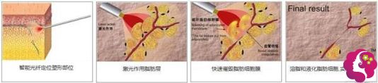 光纤溶脂瘦脸的手术步骤简易图