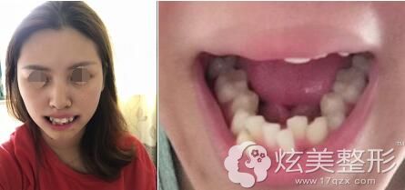 矫正术前牙齿歪斜凌乱