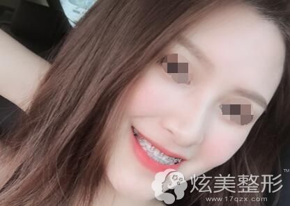 带着金属自锁托槽矫正的牙齿