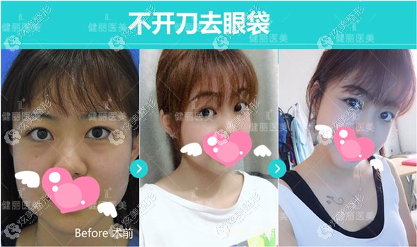 美诗沁针对轻度去眼袋做手术的效果