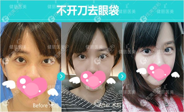 中度眼袋到美诗沁手术后的真实反馈