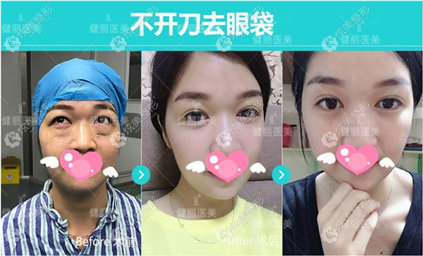 重度眼袋+泪沟术前术后的对比效果