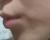 【呼啦啦】我的玻尿酸丰下巴，终于变成有型的下巴咯～ ～