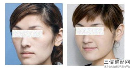 杭州激光淡化面部老年斑术价格受啥因素影响