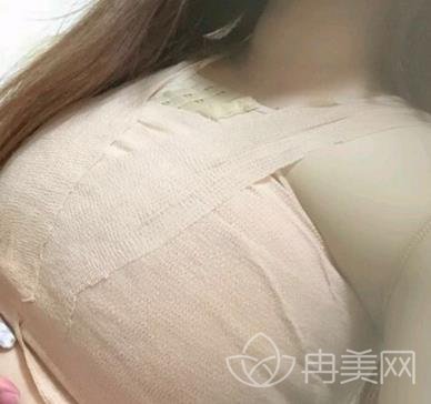 上海长征医院江华胸部下垂矫正一个月恢复案例展示