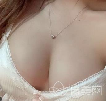 上海长征医院江华胸部下垂矫正一个月恢复案例展示