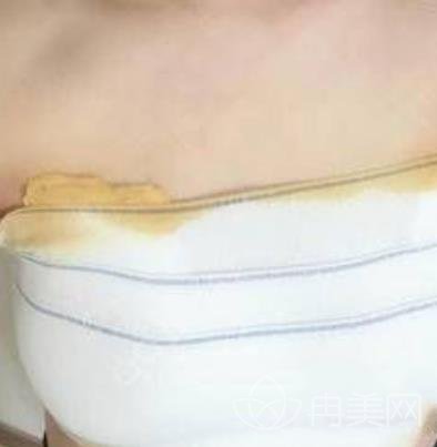 上海美莱汪灏隆胸修复经历分享，性感丰满的胸部让我更自信