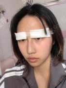 桂林医学院附属医院割双眼皮案例效果图公布！再看眼整形价格表！