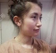 河南省人民医院侴海燕双眼皮怎么样？可以来看案例亲身术后恢复照片