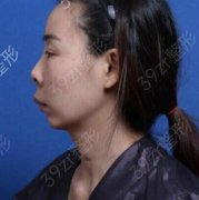 济南中心医院鼻综合案例效果图分享_附鼻部整形价格一览