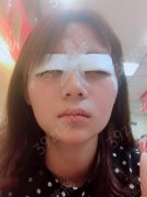 广州军区总医院双眼皮整形价格表！双眼皮案例发布及价格表参考！