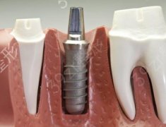 种植牙齿的危害和副作用是什么？