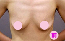 乳房下垂矫正