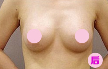 乳房下垂矫正