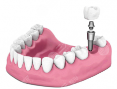国产种植牙多少钱一颗？2021价格表+效果图分享，质量可靠！