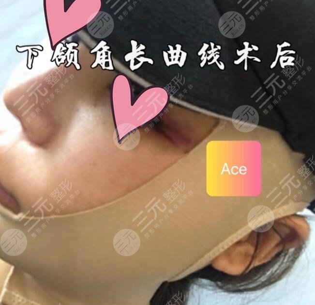 上海九院整形科磨骨手术术后一周