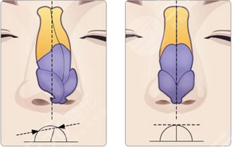 上海市东方医院整形美容中心歪鼻矫正原理