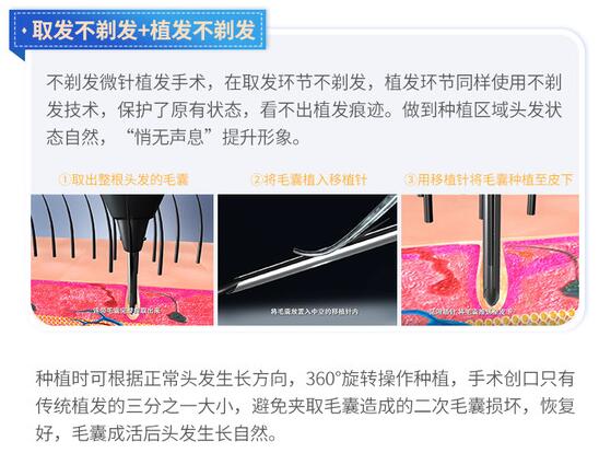 大麦微针植发