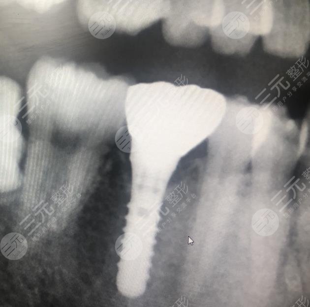 杭州美奥口腔医院种植牙案例分享