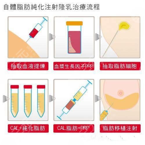 国内脂肪填充穆大力医生自体脂肪填充相关问答：缺点