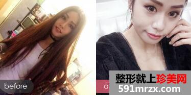 做了大腿抽脂填充丰胸价格不贵恢复效果好真实案例分享