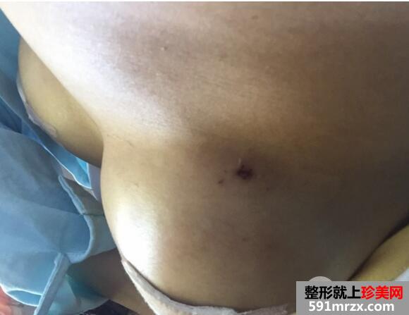 自体隆胸手术失败修复沈阳美莱真实案例分享