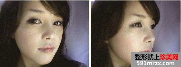 长沙雅美医疗美容医院隆鼻怎么样