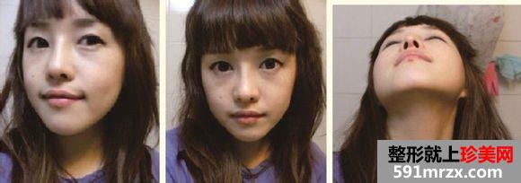 长沙雅美医疗美容医院隆鼻怎么样