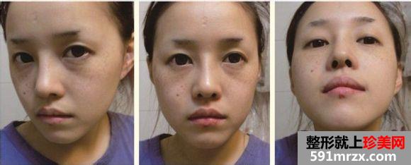 长沙雅美医疗美容医院隆鼻怎么样