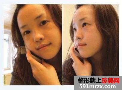 长沙雅美医疗美容医院隆鼻怎么样