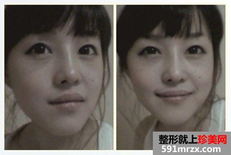 长沙雅美医疗美容医院隆鼻怎么样