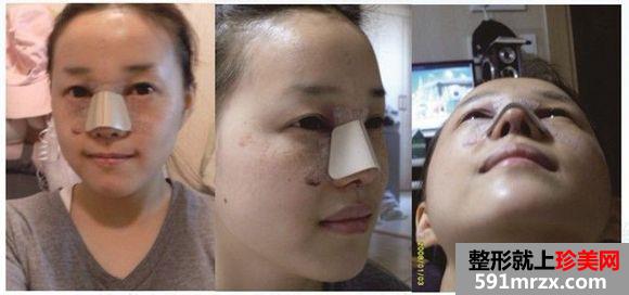 长沙雅美医疗美容医院隆鼻怎么样