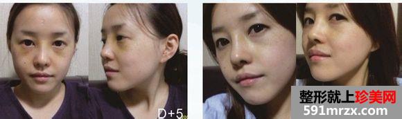 长沙雅美医疗美容医院隆鼻怎么样
