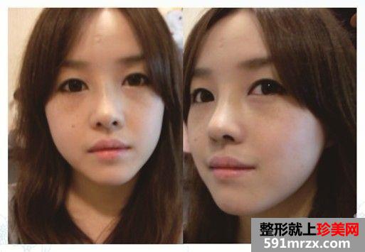 长沙雅美医疗美容医院隆鼻怎么样