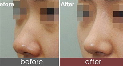 硅胶假体隆鼻可以维持多少年