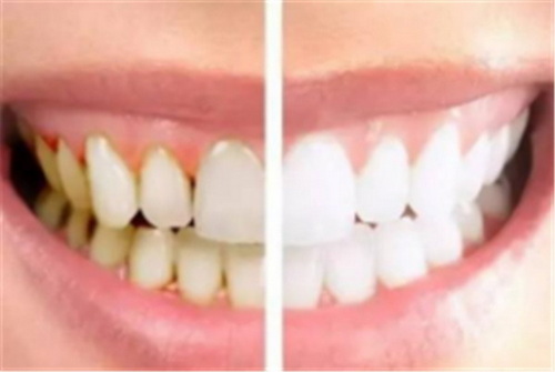 小苏打刷牙会使牙齿变白