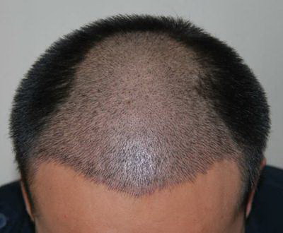 油脂性脱发是什么原因造成的