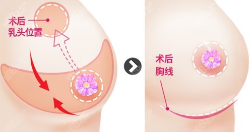 韩国id医院做缩胸手术