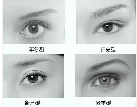 双眼皮的类型有哪些