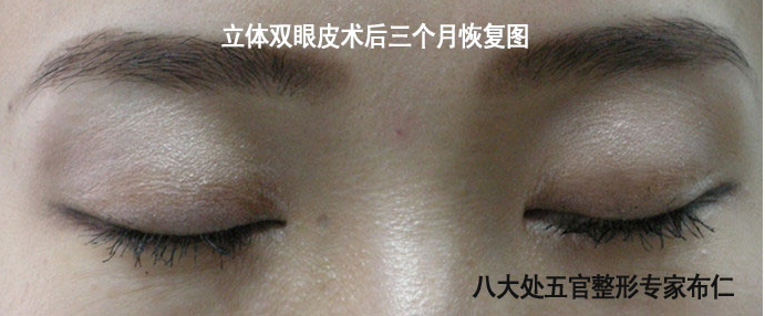 北京八大处布仁立体皮瓣式缝合双眼皮手术