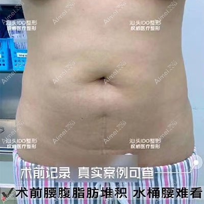 在汕头做360水动力腰腹环吸经历：术后疼了3天腰围瘦了10cm