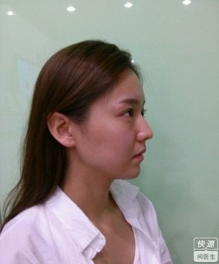 玻尿酸填充