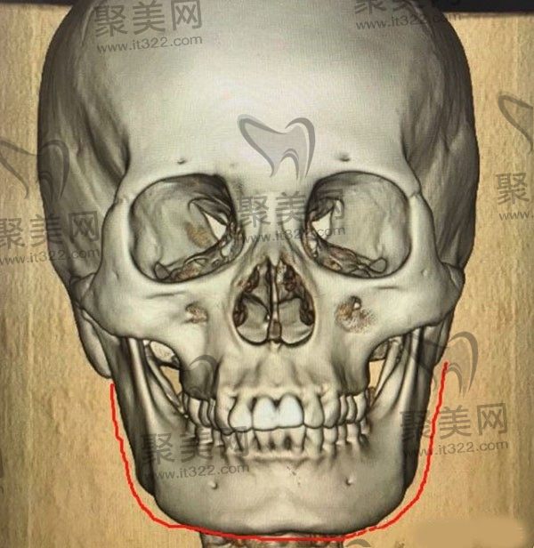 切除下颌角后悔死了，内行人回答下颌角手术失败率多高