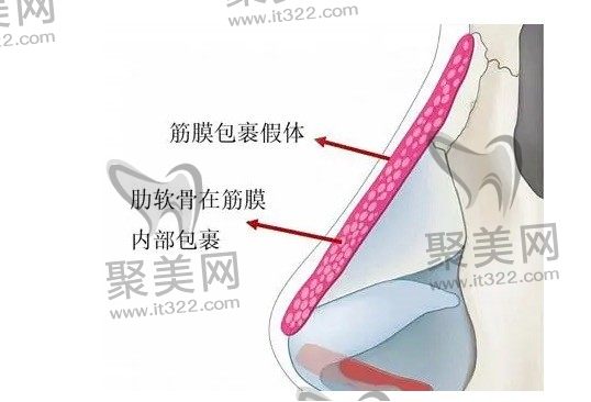 隆鼻修复要多久才能二次修复？肋骨鼻二次修复困难吗？