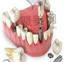 种植牙和义齿的区别有哪些？对比优缺点看哪个更好一点