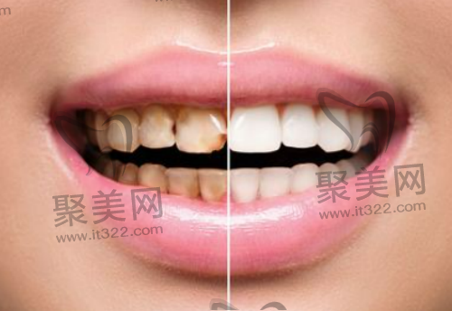 不同阶段的四环素牙图片分享，来看四环素牙和氟斑牙有什么区别？