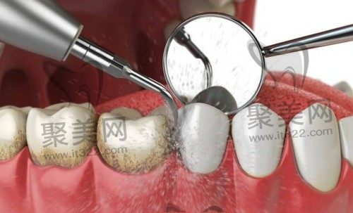 牙齿喷砂对牙齿有伤害吗？洗牙是喷砂好还是超声波好？
